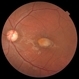 Torpedo Maculopathy Torpedo Maculopathy