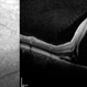 Preeclampsia in a 30-Year-Old - OCT- LE Preeclampsia in a 30-Year-Old - OCT- LE