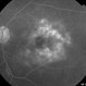 Macular Telangiectasia (FA Late Phase) Macular Telangiectasia (FA Late Phase)