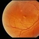 Vitreous Traction on Disc / PVD Vitreous Traction on Disc / PVD
