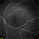 Lipemia Retinalis FA Lipemia Retinalis FA
