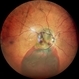 Idiopathic Polypoidal Choroidal Vasculopathy Idiopathic Polypoidal Choroidal Vasculopathy