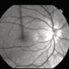 Choroidal Folds Choroidal Folds