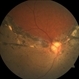 Spontaneous reattachment of retina Spontaneous reattachment of retina