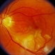 Branch Retinal Artery Occlusion (BRAO)