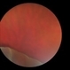 Retinal Dialysis (Superior) and Macula Off Detachment
