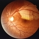 Branch Retinal Artery occlusion Branch Retinal Artery occlusion