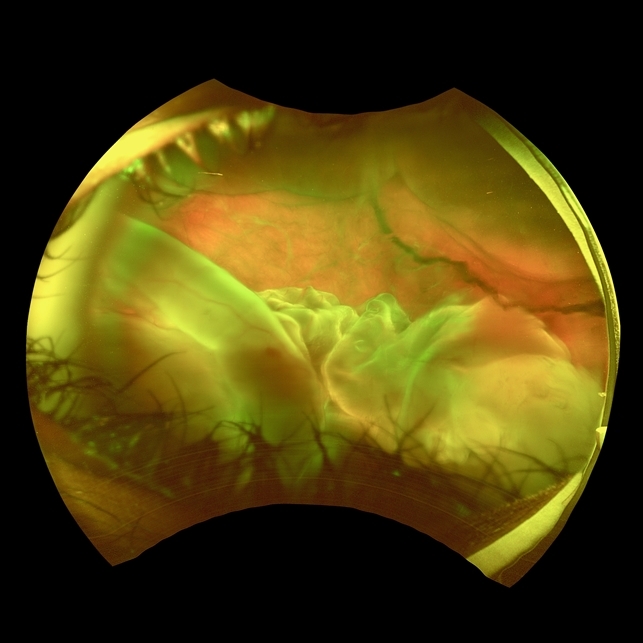 Traumatic Giant Retinal Tear Associated Retinal Detachment ...