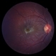 Photic Retinopathy Photic Retinopathy