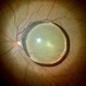 Post traumatic dislocated crystalline lens Post traumatic dislocated crystalline lens