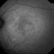 Macular Telangiectasia (Auto Fluorescence) Macular Telangiectasia (Auto Fluorescence)