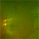Retinal Capillary Hemangioma Retinal Capillary Hemangioma