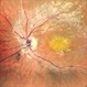 Macular Dystrophy Macular Dystrophy