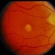 Adult Foveomacular Dystrophy / Pattern Adult Foveomacular Dystrophy / Pattern
