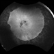 Alagille Syndrome UWF Autofluorescence Alagille Syndrome UWF Autofluorescence