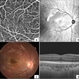 Absence of Macular FAZ in a Child After Laser Therapy for Retinopathy of Prematurity Absence of Macular FAZ in a Child After Laser Therapy for Retinopathy of Prematurity