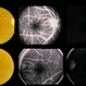 PE Cysts PE Cysts