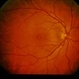 Idiopathic Pre-Retinal Membrane / Vitritis Idiopathic Pre-Retinal Membrane / Vitritis