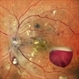Proliferative Diabetic Retinopathy