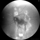 Chronic Central Serous Chrorioretinopathy Chronic Central Serous Chrorioretinopathy