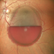 Subhyaloid Haemorrhage