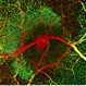 Retinal Macroaneurysm (RAM) Retinal Macroaneurysm (RAM)