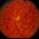 Venous Stasis Retinopathy Venous Stasis Retinopathy