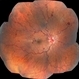 Multiple Blot Hemorrhages and Roth Spots Multiple Blot Hemorrhages and Roth Spots