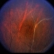 Multiple Sclerosis