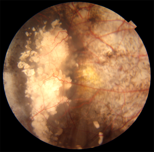 Retinoblastoma - Retina Image Bank