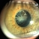 Anterior Capsular Opacity