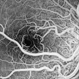 Retinal Arteriovenous Malformations (Racemose Hemangiomatosis)