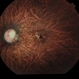Macular Dystrophy vs Myopic Degeneration Macular Dystrophy vs Myopic Degeneration
