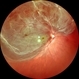 Retina Detachment