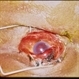 Trauma – Scleral Laceration Trauma – Scleral Laceration