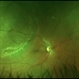 Retinoschisis + Retinal Detachment Retinoschisis + Retinal Detachment