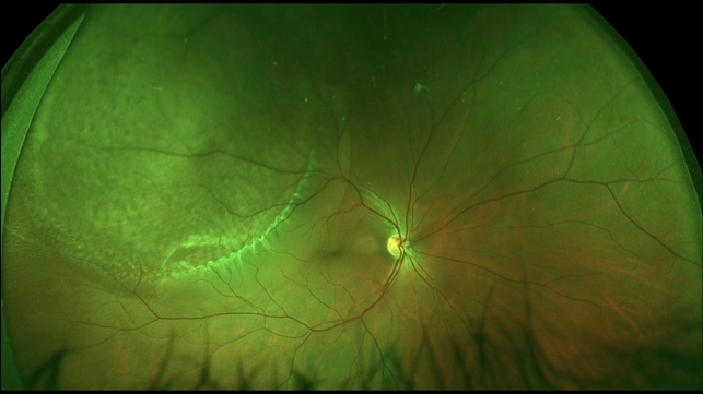 Retinoschisis + Retinal Detachment - Retina Image Bank