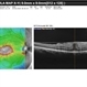 Photic Retinopathy Photic Retinopathy