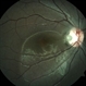 Optic Disc Pit Optic Disc Pit