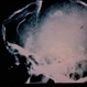 Tuberous Sclerosis Tuberous Sclerosis