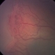 High Magnification of Stage 3 Neovascularization in ROP High Magnification of Stage 3 Neovascularization in ROP