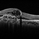 Neovascular AMD with Ring Shaped lesions