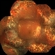Attached Retina With Lasered Retinectomy Status Post Multiple Surgeries for PVR With Presence of Silicon Oil and a PFCL Bubble Attached Retina With Lasered Retinectomy Status Post Multiple Surgeries for PVR With Presence of Silicon Oil and a PFCL Bubble