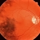 Sunset Glow Fundus Sunset Glow Fundus