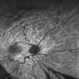 Hypotony Maculopathy Hypotony Maculopathy