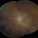 Hypotony maculopathy Hypotony maculopathy