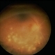Necrotizing Retinitis Necrotizing Retinitis