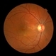 Central Serous Chorioretinopathy