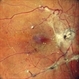 Tractional Retinal Detachment Tractional Retinal Detachment