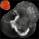 Ischemic BRVO
